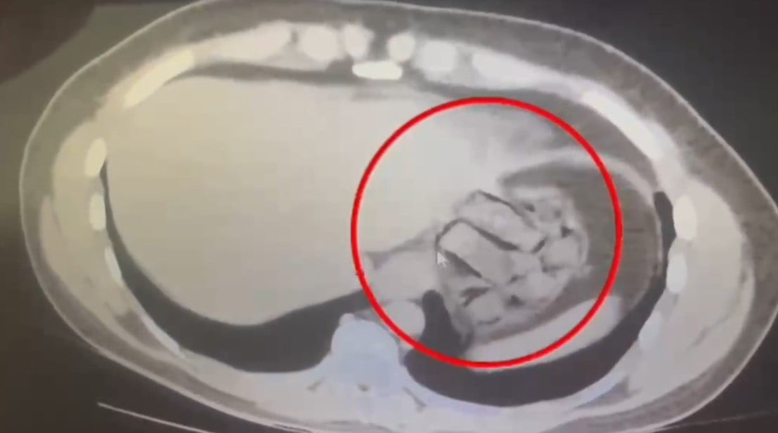 ŞAHSIN İÇ BEDEN MUAYENESİNDE 76 PARÇA HALİNDE TOPLAM 571,91 GRAM METAMFETAMİN ELE...