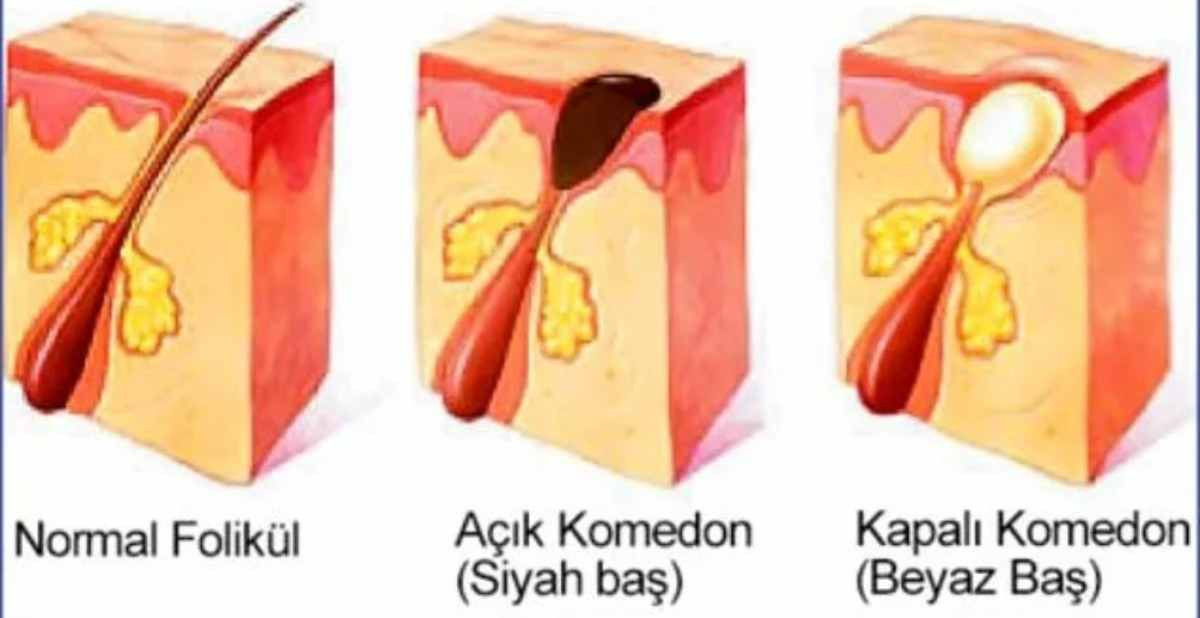 Sivilceyi sıktıktan sonra çıkan beyaz sıvının adı nedir