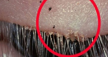 Enfeksiyon Oldu Sanılan Göze Aslında Bakın Ne Oldu?