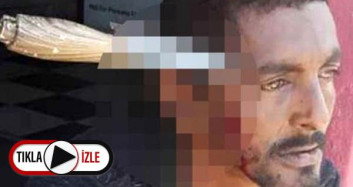 Kafasına Bıçak Saplandı, 3 Gün Sonra Hayatına Devam Etti