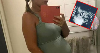 Molar Gebelik Geçiren Lauren Knowles Tümör Doğurdu