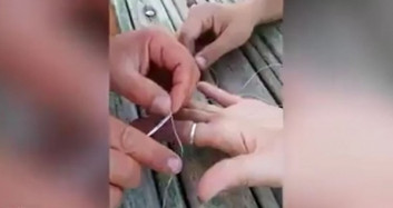 Parmakta Sıkışan Yüzüğü Çıkarma Operasyonu