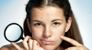 Sivilcelerden Anında Kurtulma Yöntemleri!