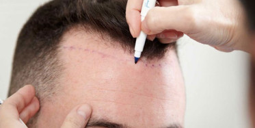 Saç Ekimi için 'Robot' Geliştirdi