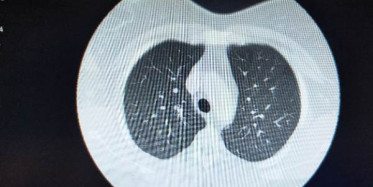 Koronavirüse Yakalanan Hastaların Ciğerlerindeki Görüntü Dehşete Düşürdü	