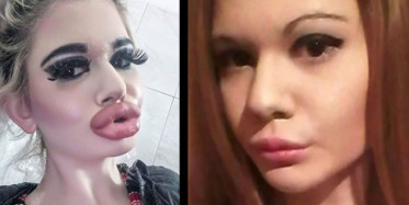 Barbie Bebeğe Benzemek İsteyen Genç Kadın 20 Kere Dudak Dolgusu Yaptırdı