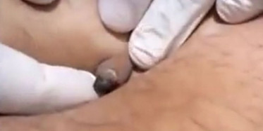 Taşlaşan Sivilceyi Görenler İnanamadı!