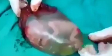 Anne Karnından Çıkartılan Cenin