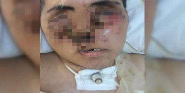 Eniştesinin Saldırısına Uğradı, Tanınamaz Hale Geldi