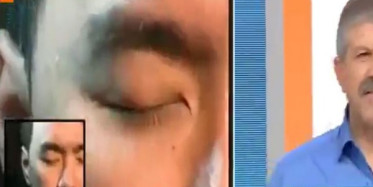 Soğan ve Sarımsağı Yüzüne Sürdü, Yüzündeki Kurtlar Döküldü!