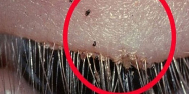 Enfeksiyon Oldu Sanılan Göze Aslında Bakın Ne Oldu?