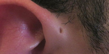 Kulağınızda Bu Delik Varsa Dikkat Edin!