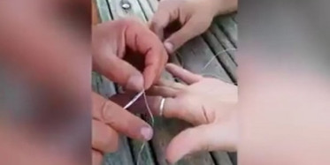 Parmakta Sıkışan Yüzüğü Çıkarma Operasyonu