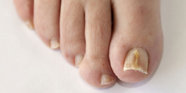 Tedavi Edilmezse Kurtuluşu Mümkün Olmayan Hastalık: Mantar