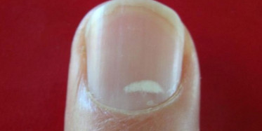 Tırnaklardaki Beyaz Lekeler Hastalıkların Habercisi!