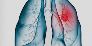 Akciğer Kanserinin Belirtileri