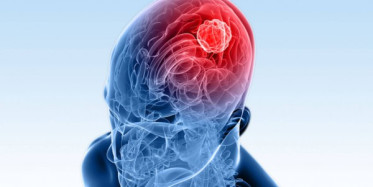 Beyin Tümörünün Belirtileri Nelerdir?