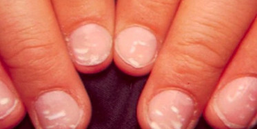 Tırnaklarda Oluşan Beyaz Lekenin Nedenleri